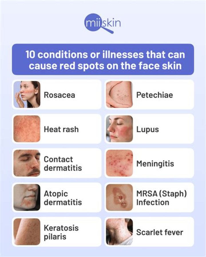 Can dairy cause red spots on face?