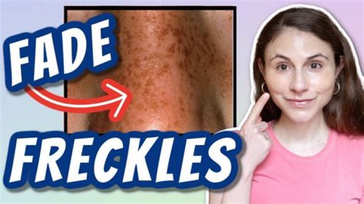 Can you fade your freckles?