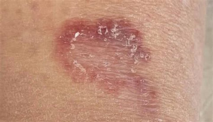 What disease gives you holes in your skin?
