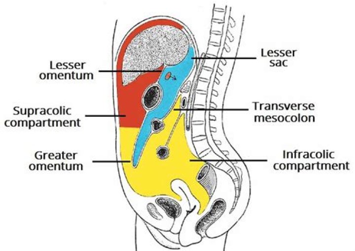 What does Hemoperitoneum mean?